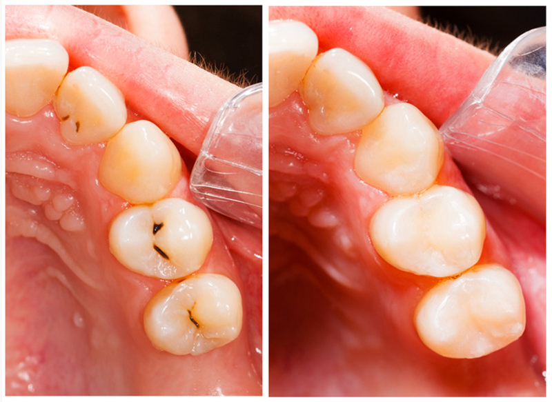 Fillings  Lexington, MA, 