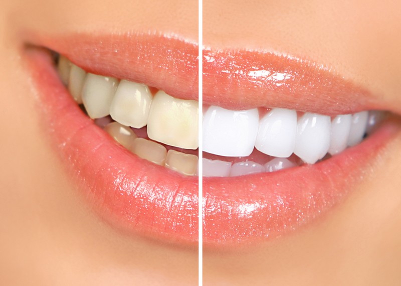 Teeth Whitening  Lexington, MA, 